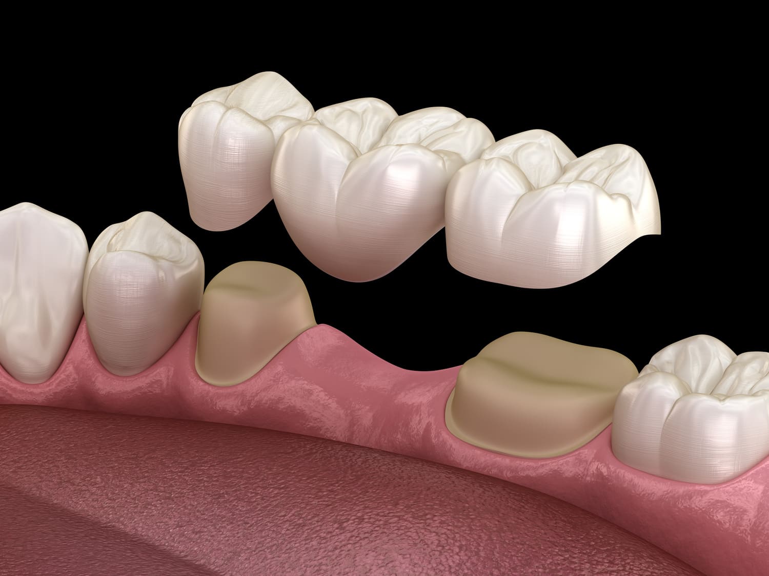 Dental Bridges Placement