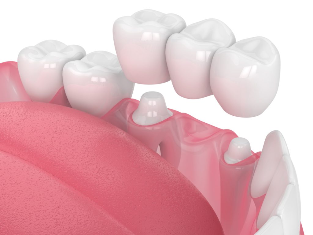 Custom Dental Crowns at Corbin Dental