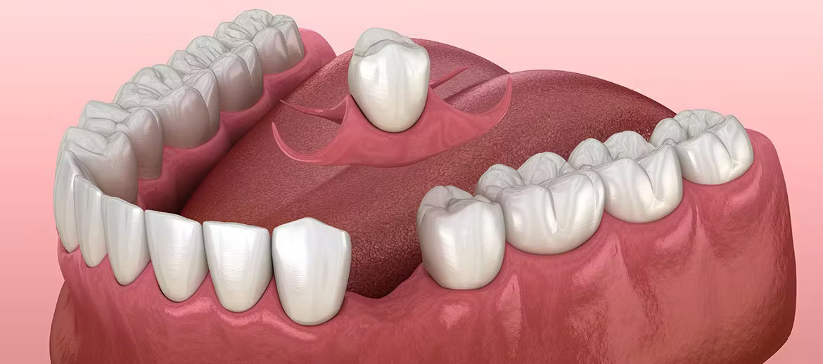 Dentures Fitting and Care