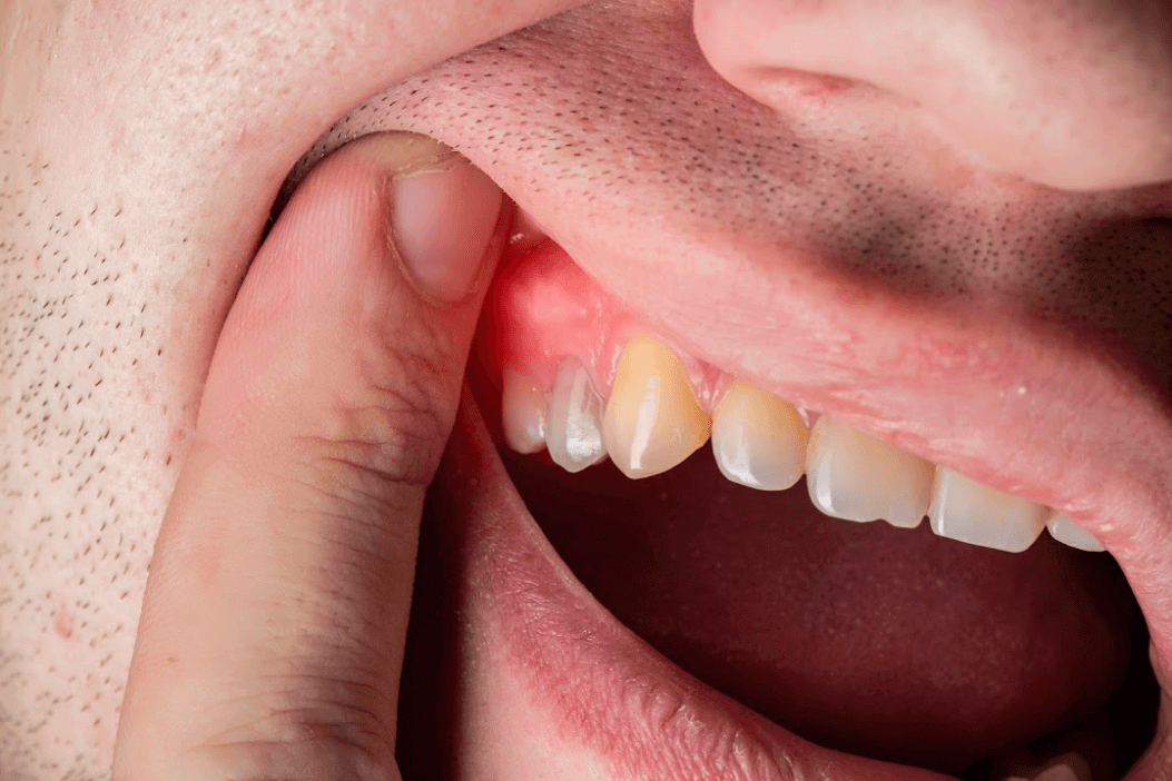 Corbin Dental - Expert Gum Disease Treatment in Bayside