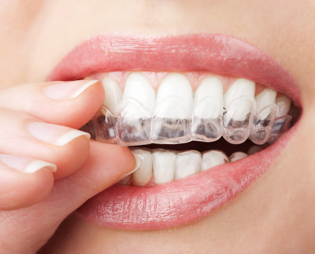 Invisalign Clear Aligners Treatment