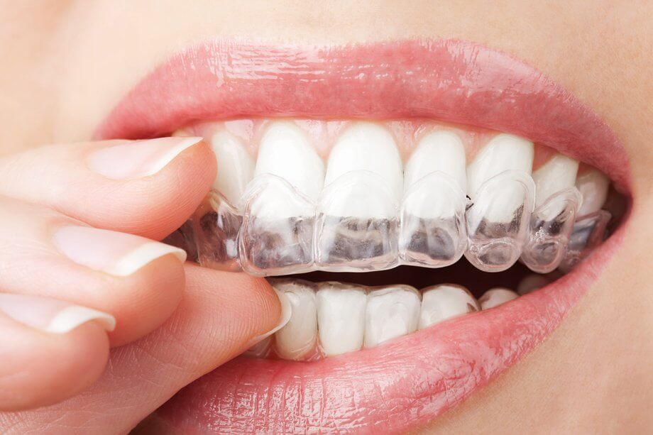 Corbin Dental in Bayside. Call 718-631-7051 for Invisalign treatment.