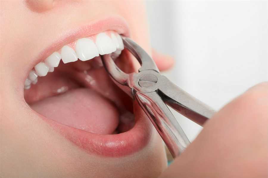 Tooth Extraction near me