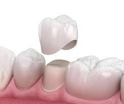 Bayside Dental Crowns by Corbin Dental