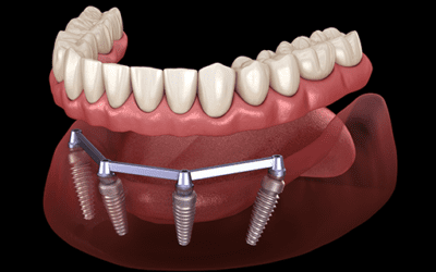 All-on-4 Dental Implants Cost: What to Expect in Pricing