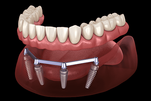 Explore affordable All-on-4 dental implants cost at Corbin Dental in Oyster Bay, NY. Contact us at 516-922-5888 for details.