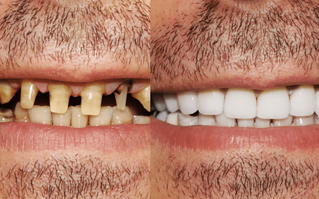 All-on-4 Dental Implants Before and After: Amazing Results